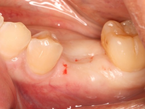 阿久井4　埋入直前・抜歯後約2.5ヶ月